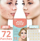 🌟 Parches Antiacné  🌟 Elimina Imperfecciones Rápidamente